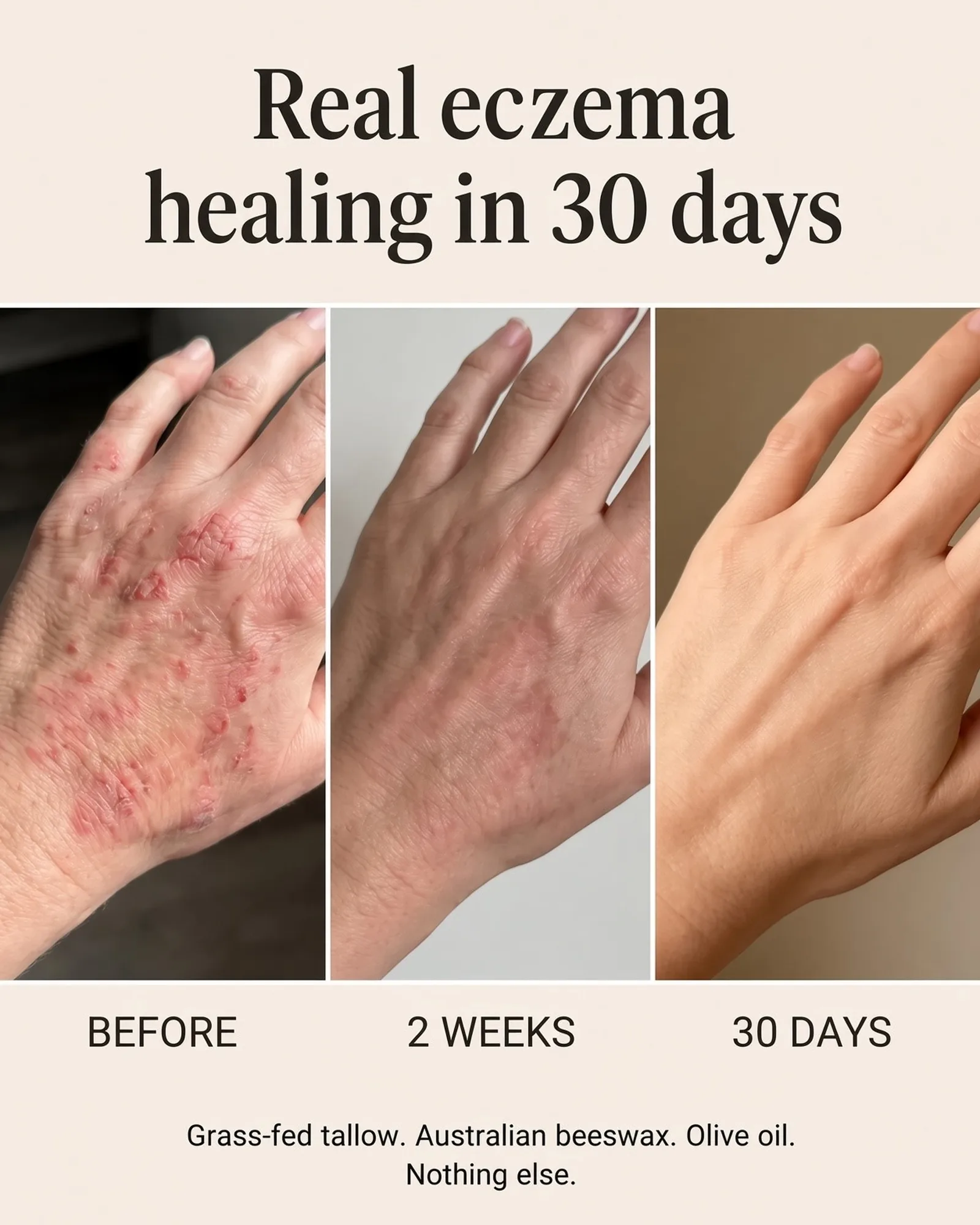 Dry, cracked skin on a hand at the start, at two weeks and at 30 days. Individual results vary